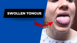Swollen tongue HELPED by Dr Suh Specific Chiropractic NYC