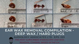 EAR WAX REMOVAL COMPILATION - DEEP WAX/HARD PLUGS - EP223