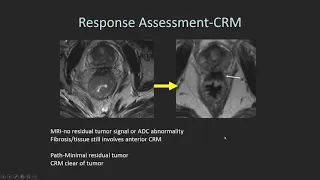 Rectal cancer imaging