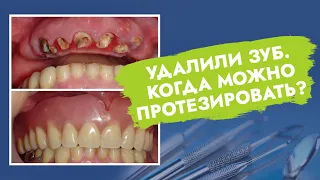Удалили зуб. Когда можно протезировать?