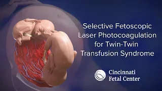 Twin-Twin Transfusion Medical Animation (TTTS) | Cincinnati Fetal Center