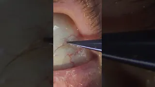 Sub-Conjunctival Eyelash Removal #shorts