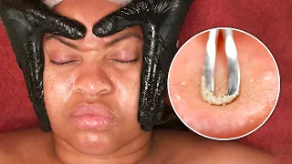 EXTREMELY SATISFYING FACIAL MASK & DERMAPLANING| Best Skincare Treatment