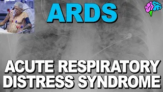 What is ARDS? Acute Respiratory Distress Syndrome