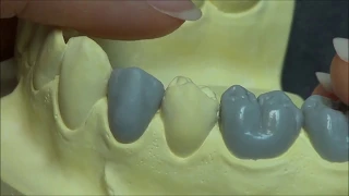 Live wax up - Lower 1st premolar (full)