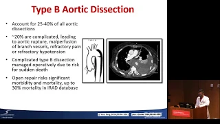 Aortic Dissection - Isaac George, MD