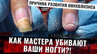 Пришла клиентка, а там😱😱 Жесткий онихолизис ногтей‼️Виды, ожог ногтевой пластины, боковой онихолизис