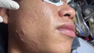 Acne Treatment Huong Da Nang#601 _ 2024  #blackheads