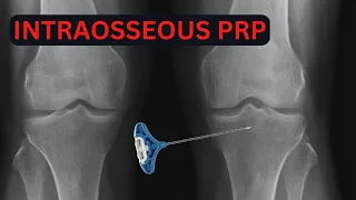 Intraosseous PRP Injection For Knee Osteoarthritis