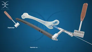 Surgical Technique Femur Interlocking Nail Matrix Meditec