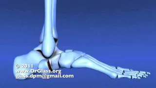 Evans Calcaneal Osteotomy of the Flat Foot