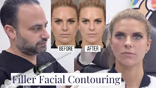 Beverly Hills Facial Fillers | Los Angeles Cosmetic Jawline and Neckline Improvement | Dr. Ben Talei
