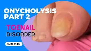 Toenail Disorder -Onycholysis -Part 2- Did you know this could be a result of nail trauma?