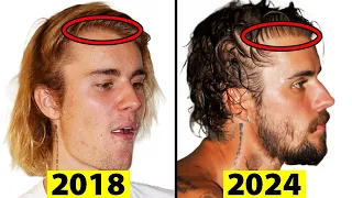 Did Justin Bieber Have a Hair Transplant?
