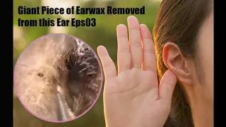 Giant Piece of Earwax Removed from this Ear Eps04