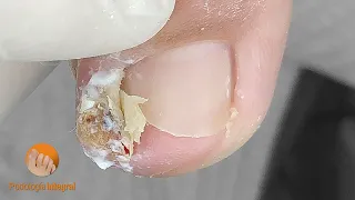 I proceed very carefully to decompress the area and remove the spicule | Onychocryptosis + granuloma