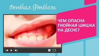 Чем опасна гнойная шишка на десне❓🤯