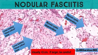 Nodular fasciitis 101 - tips & tricks for diagnosis (pathology dermpath dermatology)