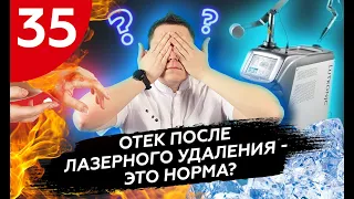 Отек после лазерного удаления - это норма?