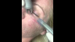 CO2 laser resurfacing for acne, wrinkles, pores, skin tightening, complexion, tone, lines, facial