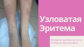 Узловатая эритема