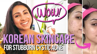 My Korean Skincare Routine that Saved Me! (Does Accutane Work?)