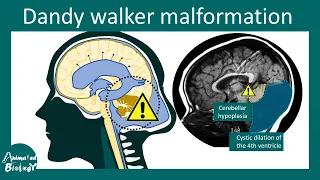 Dandy Walker Malformation | Diagnosis symptoms and treatment