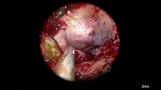 Use of Ipsilateral Nasoseptal Flap for Skull Base Reconstruction after a Transpterygoid Approach