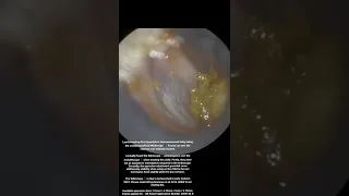 25 - Paediatric Ear Wax Removal with the WAXscope®️