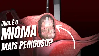 Qual é o MIOMA mais perigoso?