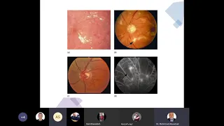 Lecture 5  Retinal Vascular disease