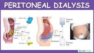 Peritoneal Dialysis: Introduction, Physiology, Technique, Modes and Complications