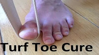 Turf Toe Treatment [1 Min Home Remedy]