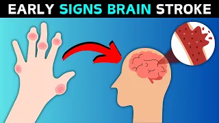 10 Warning Signs of Stroke One Month Before It Happens