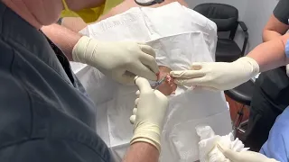 Dr. Cyst Popper WARNING - GRAPHIC 35+ YEAR OLD CYST REMOVAL    Mature audiences only