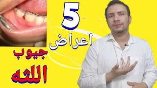 5 اعراض تدل علي ان لديك جيوب في الاسنان و اللثه