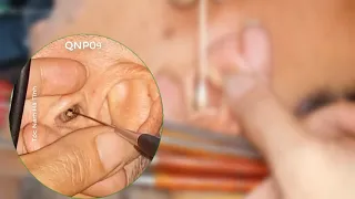 Top Video ear wax removal most impressive 2019 part 08