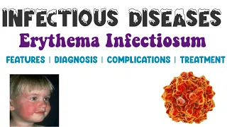 Erythema Infectiosum | Viral Infections | Infectious Diseases 3 | Medicine