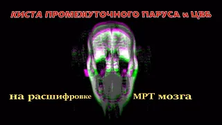 КИСТА промежуточного паруса и ДИСЦИРКУЛЯТОРНАЯ ЭНЦЕФАЛОПАТИЯ на МРТ головного мозга с РАСШИФРОВКОЙ