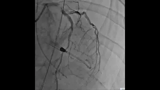 95% Stenosis of Distal Left Main Extending into the Ostial LAD & LCX in Left Anterior Oblique View