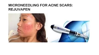 Acne scar treatment: Microneedling and Fillers!