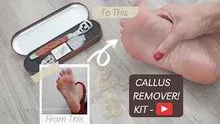 Say Goodbye to Thick Calluses with this Amazing Callus Remover - Watch it in Action!