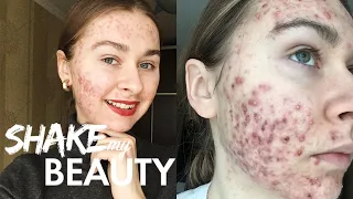 I'm Finally Happy To Show My Acne On Instagram | SHAKE MY BEAUTY