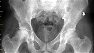 Avascular necrosis (AVN) of hip