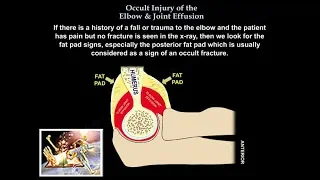 Occult Injury Of The Elbow & Joint Effusion - Everything You Need To Know - Dr. Nabil Ebraheim