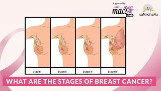 What are the stages of breast cancer