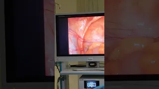 laparoscopic Intraperitoneal pelvic anatomy...