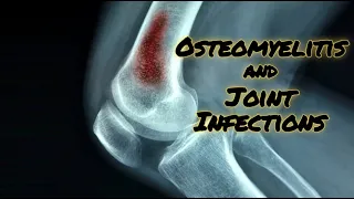 Osteomyelitis and Joint Infections - CRASH! Medical Review Series