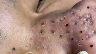 Treatment of Blackheads on The bridge of the Nose