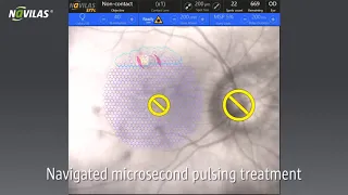 Navigated Microsecond Pulsing Treatment with the Navilas Retina Laser